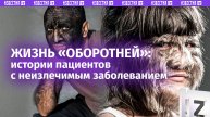 «Синдром оборотня»: неизлечимое избыточное оволосение превращает жизнь в кошмар / Известия