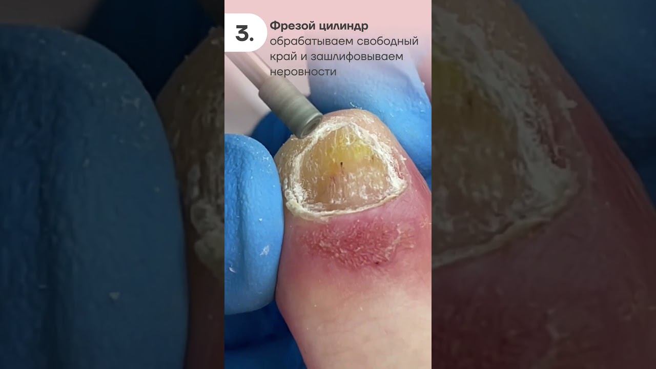 Как работать с псориазом?