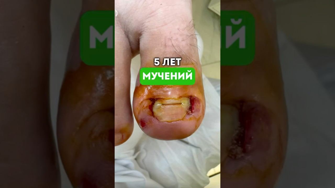 5 лет мучений… #подолог #подологмосква