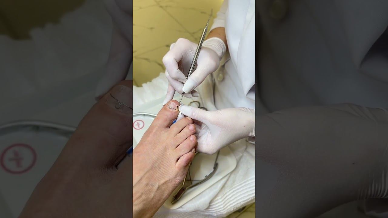 Как понять, что у вас вросший ноготь? #подолог #подологмосква