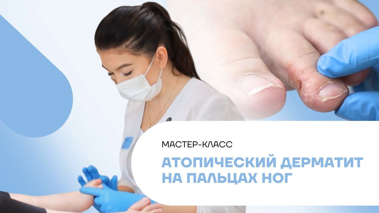 Обработка стопы с атопическим дерматитом