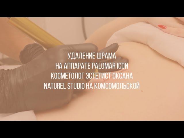 Удаление шрама на аппарате Palomar icon в Naturel Studio