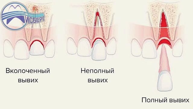 Вывих зуба, Вагабов Г.Б, стоматология Айсберг+ на Доблести 26