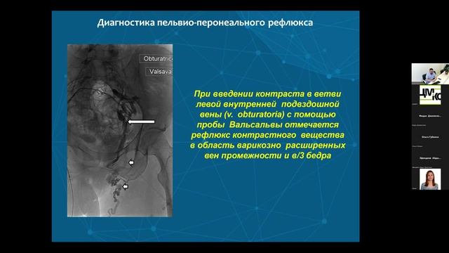 Панков А.С. Эндоваскулярное лечение варикозного расширения тазовых вен у женщин. 27.04.2023.