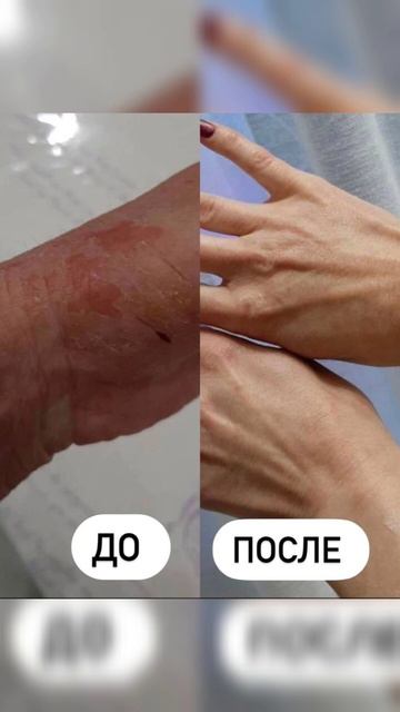 МОИ КЕЙСЫ ПО АТОПИЧЕСКОМУ ДЕРМАТИТУ