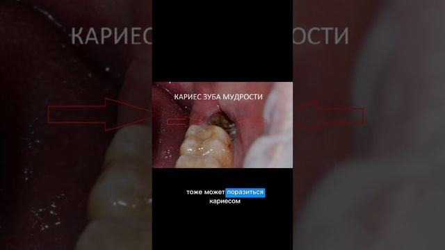 ПОЧЕМУ НЕ ПРОРЕЗЫВАЮТСЯ ЗУБЫ МУДРОСТИ?🦷