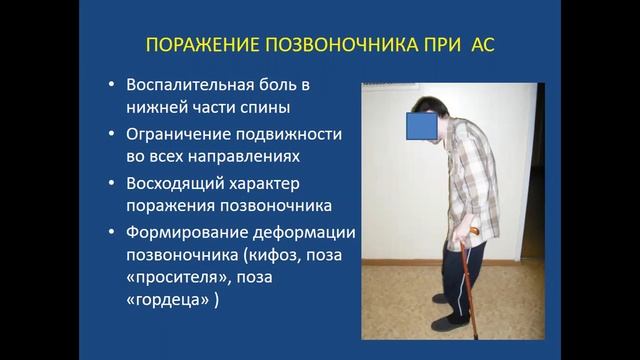 B007 Спондилоартриты Годзенко А. А.