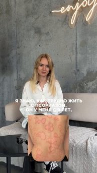 Только человек с псориазом может знать, какого это жить с псориазом.