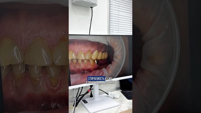 Установили виниры и коронки и получили красивую улыбку 👄