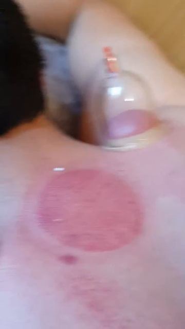 Хиджама | hijama | cupping therapy | в южном Дагестане (краткий процесс)