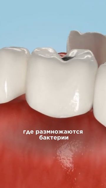 Кариес