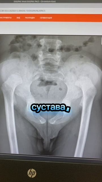 ПЕРЕКОС ТАЗА😨