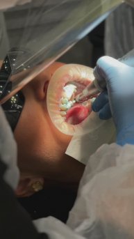 Процесс профессиональной гигиены полости рта. Врач: Штраух Ксения Викторовна