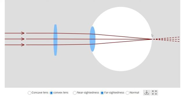 How is  Myopia different from HYPEROPIA ?  2 Min ONLY