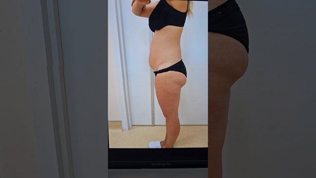 Результат операции абдоминопластика с липосакцией и липоскульптурой. Год после операции.