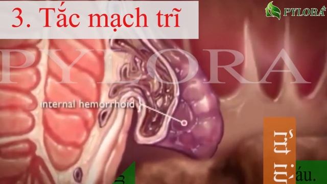 [PyLoRaTV] - PHÒNG NGỪA 6 BIẾN CHỨNG NGUY HIỂM CỦA BỆNH TRỊ BẰNG THUỐC DƯỢC THẢO PYLOVAR