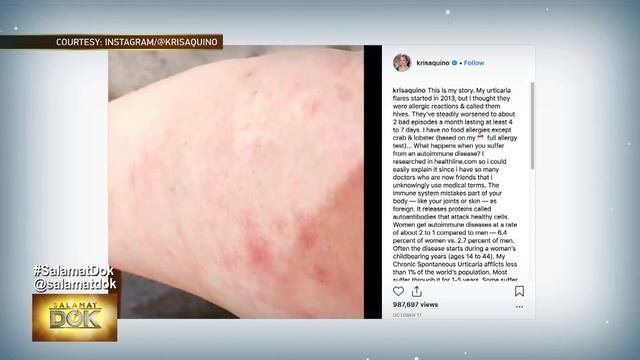 Salamat Dok: Tests to detect urticaria