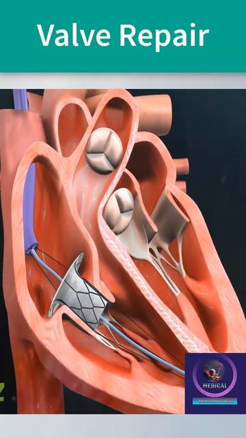 Valve Repair | Mitral Valve Repair | #shorts #heart #youtubeshorts