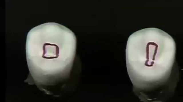 Endodontic Cavity Preparation - Phase I - Posterior