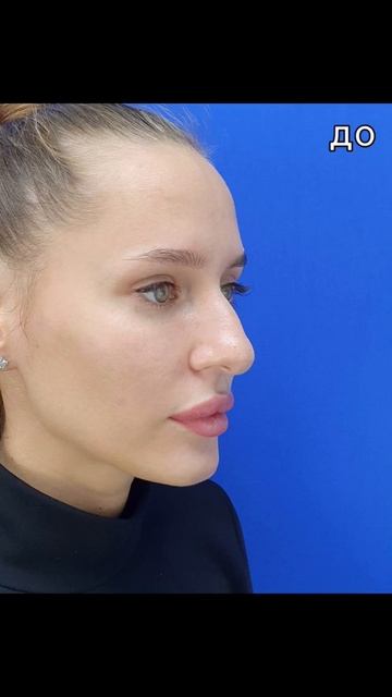 Отдалённый результат ринопластики.
2.5 года после операции.