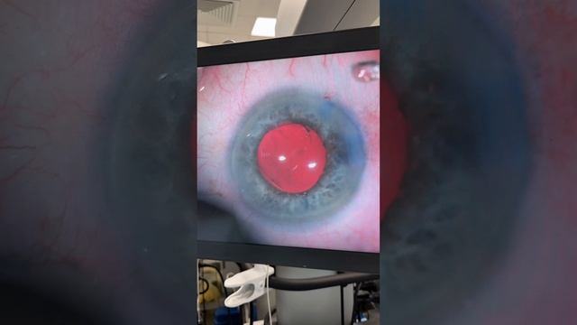 Зрелая катаракта глаза. Лечение. Нужно ли ждать пока катаракта "созреет"?