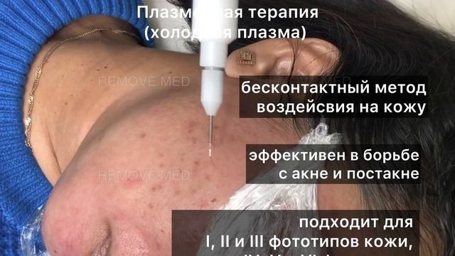 Холодная плазма, акне, типы кожи