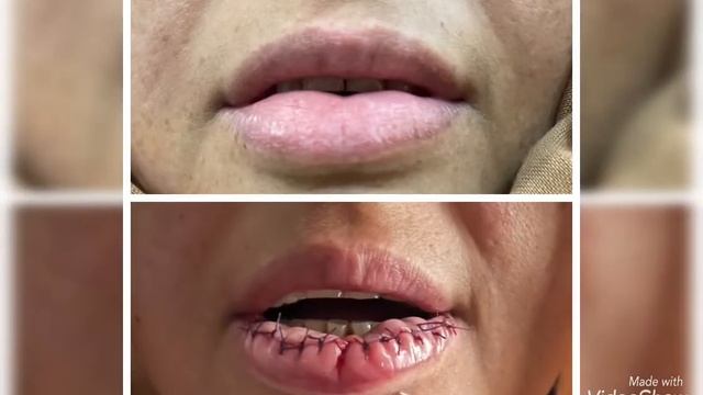 Lip reduction surgery Pakistan, doctor Saleem