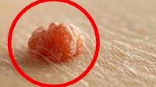 Аёллар ва эркаклар жинсий аъзосида тошмалар