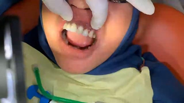 Composite veneer