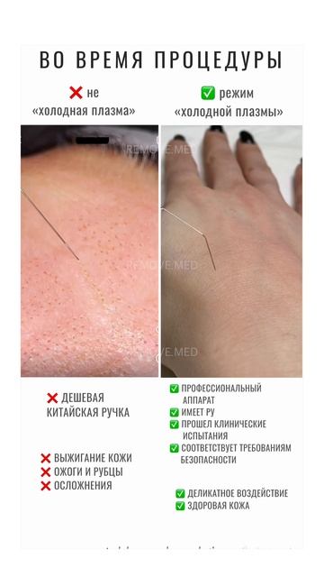 Холодная плазма и плазмапен (горячая плазма), отличия.