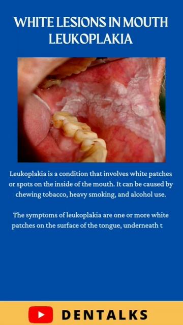 #shorts #orallesions Oral Lesions part 2 | Educational Series | Leukoplakia | വായിലെ വെള്ള പാടുകൾ