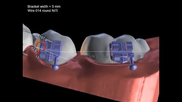 20201128 Force system from reverse curve of Spee