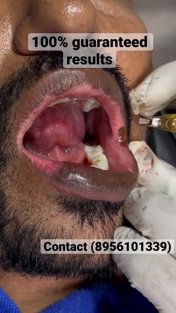 Vitiligo patient from Hyderabad | lip vitiligo treatment |100% guaranteed #trending #shorts