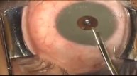 Eye Color Modification with iris implant Brightocular
