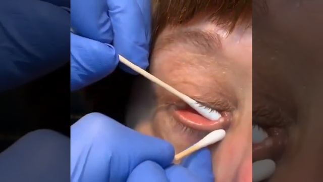 stye chalazia infection of eye