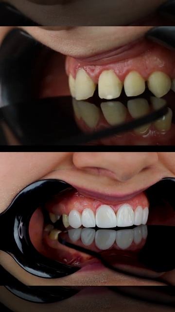 diastema closure with composite resin