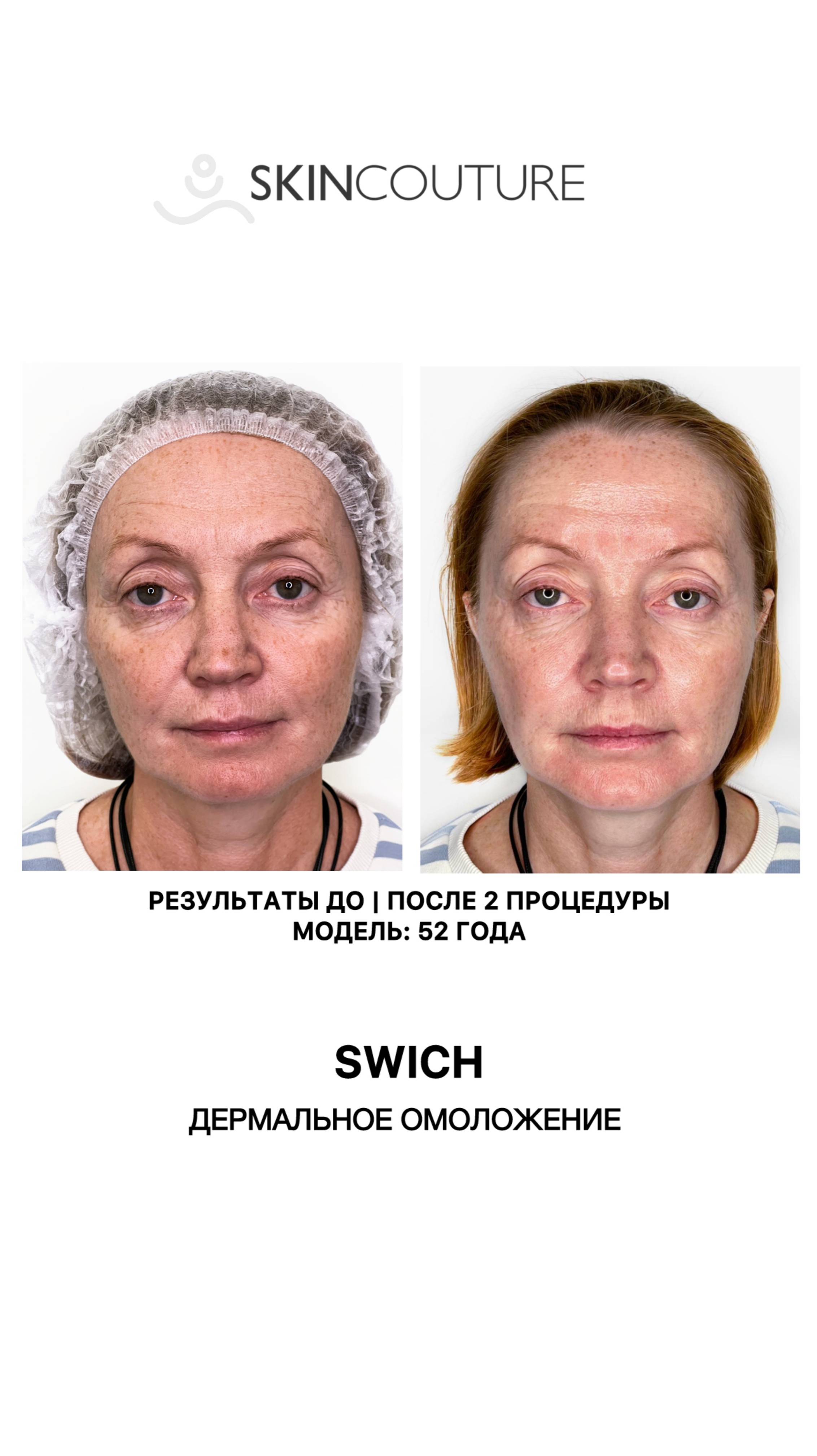SWICH до после 52 года