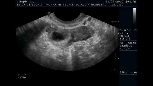 Ectopic pregnancy: unruptured