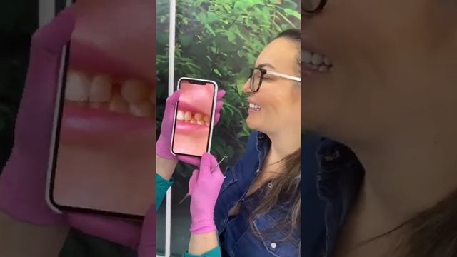 Fechamento de Diastema - Lentes de Contato em resina Composta