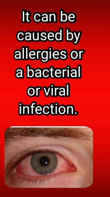 What is Conjunctivitis??? #drprashna #shortvideo #homeopathy #viral #trending