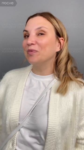3 месяца после пластики носа.