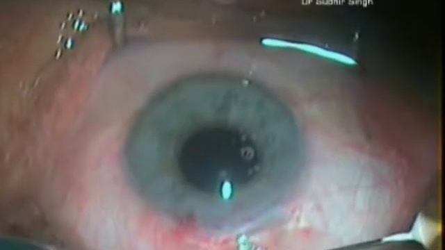 IntraTunnel Phaco Fracture Manual Cat Refractive Surg Approach 2018