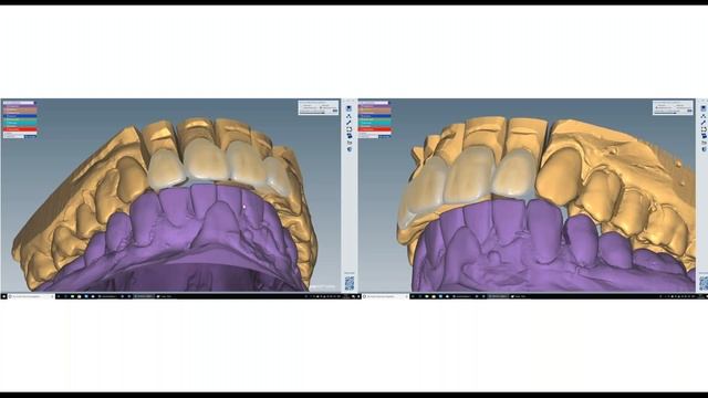 Use of different Zolid zirconia types in everyday dental practice