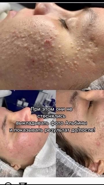 Как обманывают пациентов с #акне Я #врач и я знаю как лечить. Больше информации в профиле ⬆️.mp4