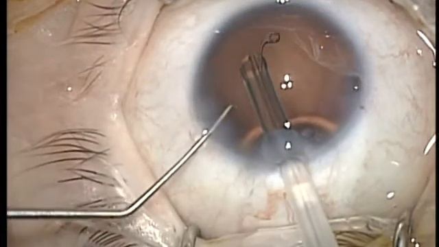 humanoptics artificial iris in congenital aniridia