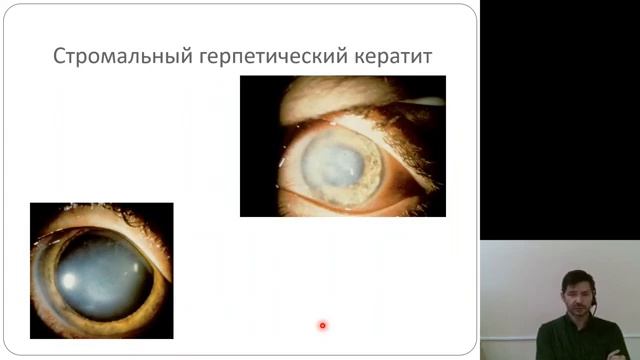 Офтальмология 2.Кератиты  Ивановский ГМУ. Дистанционное обучение