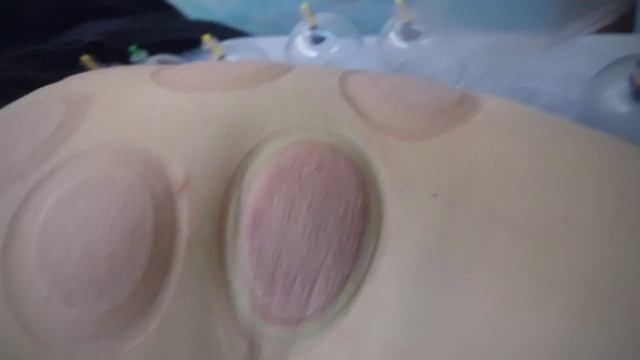 вакуумная коррекция области ягодиц