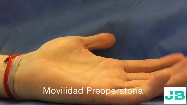 Secuela postraumática articular del dedo meñique