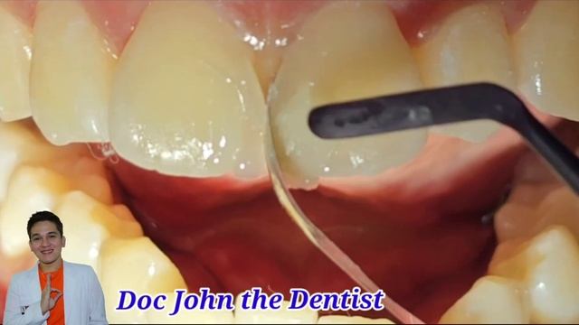 DIASTEMA CLOSURE ( COMPOSITE BONDING )