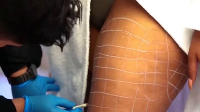 CELLULITE SOLUTIONS: CECCARELLI OR LIPOLYTIC INJECTIONS